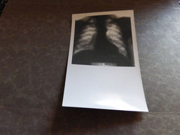 Carte Photo Radiographie Ensemble Des Côtes D'un Homme - Rare Curiosité - Santé