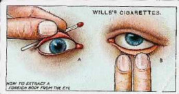 ► Chromo Wills's Cigarettes   How To Extracta Foreign Body From The Eye - Wills
