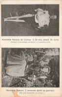 PHOTOGRAPHIE  - Henriette Hauton Pendant Et Après Sa Maladie - Carte Postale Ancienne - Photographs