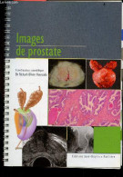 IMAGES DE PROSTATE - Prostate Normale, Hyperplasie A Predominance Fibreuse / Glandulaire - Hyperplasie Prostatique Compl - Health